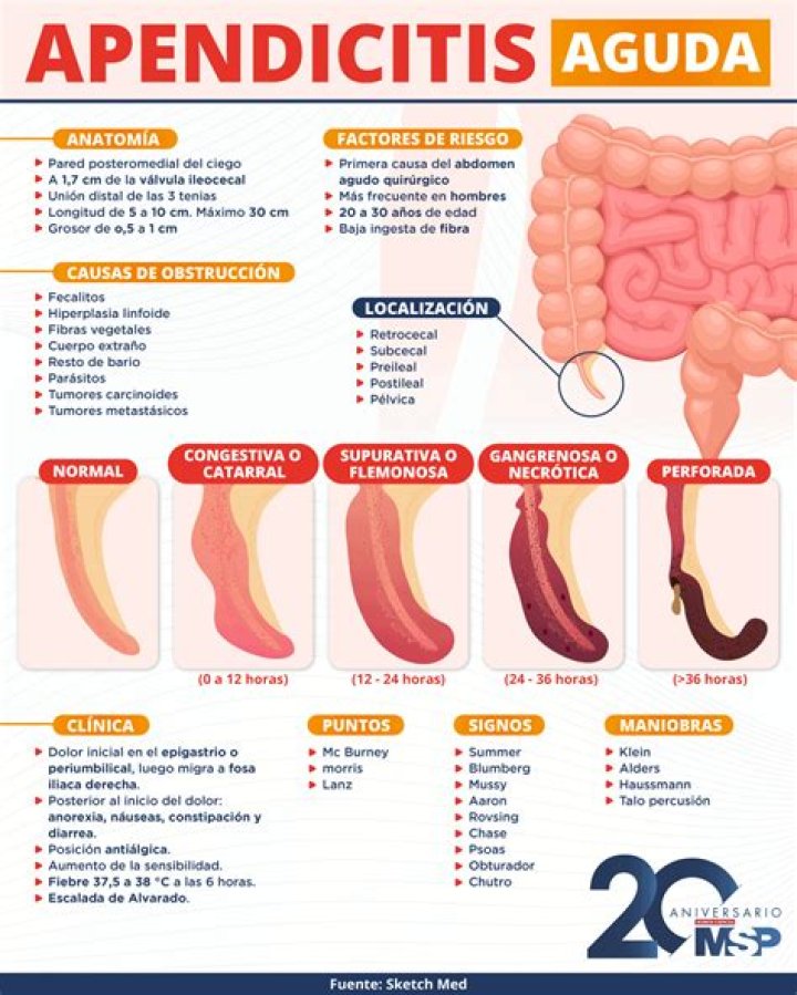 ¿La 'fórmula' para evitar la temida cirugía de apendicitis?
